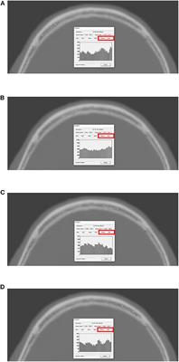 Effects of Possible Osteoporotic Conditions on the Recurrence of Chronic Subdural Hematoma